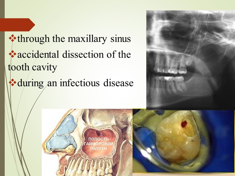 through the maxillary sinus accidental dissection of the tooth cavity during an infectious disease